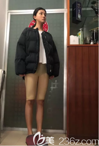 吸脂一個(gè)月的樣子