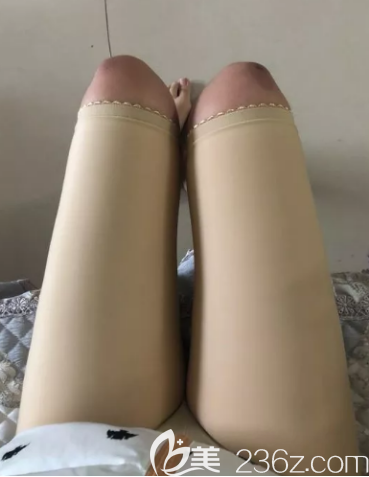 吸脂兩個(gè)月的樣子