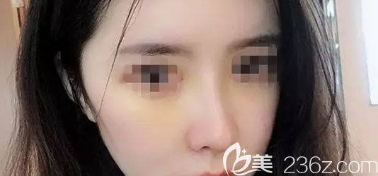 包頭葉子張會(huì)堂鼻綜合隆鼻第七天拆線后照片