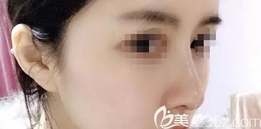 假體隆鼻半個(gè)月效果