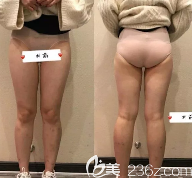 吸脂術(shù)前照片 吸脂術(shù)前照片
