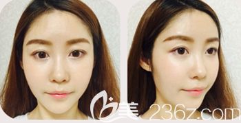 韓國然美之做全臉脂肪填充+鼻子微整形術后7天