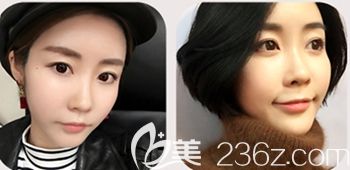 韓國然美之做全臉脂肪填充+鼻子微整形術后15天