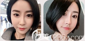 韓國(guó)然美之做了全臉脂肪填充+鼻子微整形之后2個(gè)月恢復(fù)的就很不錯(cuò)
