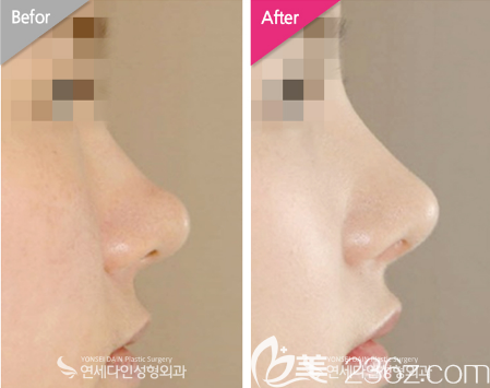 韓國(guó)延世多仁整形醫(yī)院金均泰鼻綜合隆鼻<span style= 韓國(guó)延世多仁整形醫(yī)院金均泰鼻綜合隆鼻<span style=