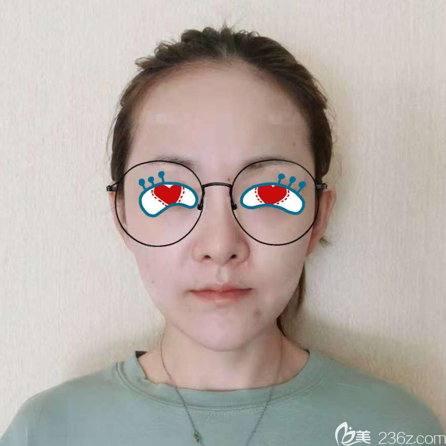 楊鵬做做完自體脂肪填充第7天 楊鵬做做完自體脂肪填充第7天