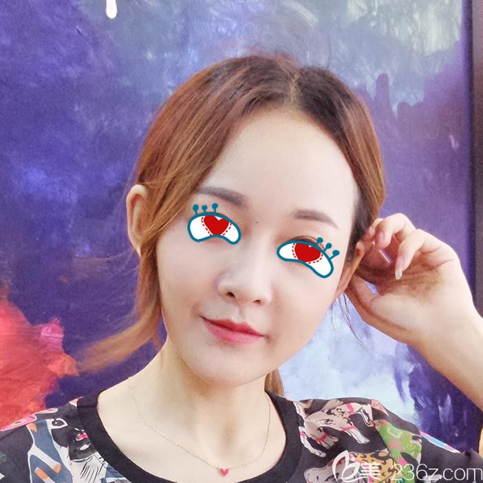 在合肥華美做全臉填充自體脂肪一個(gè)月 在合肥華美做全臉填充自體脂肪一個(gè)月