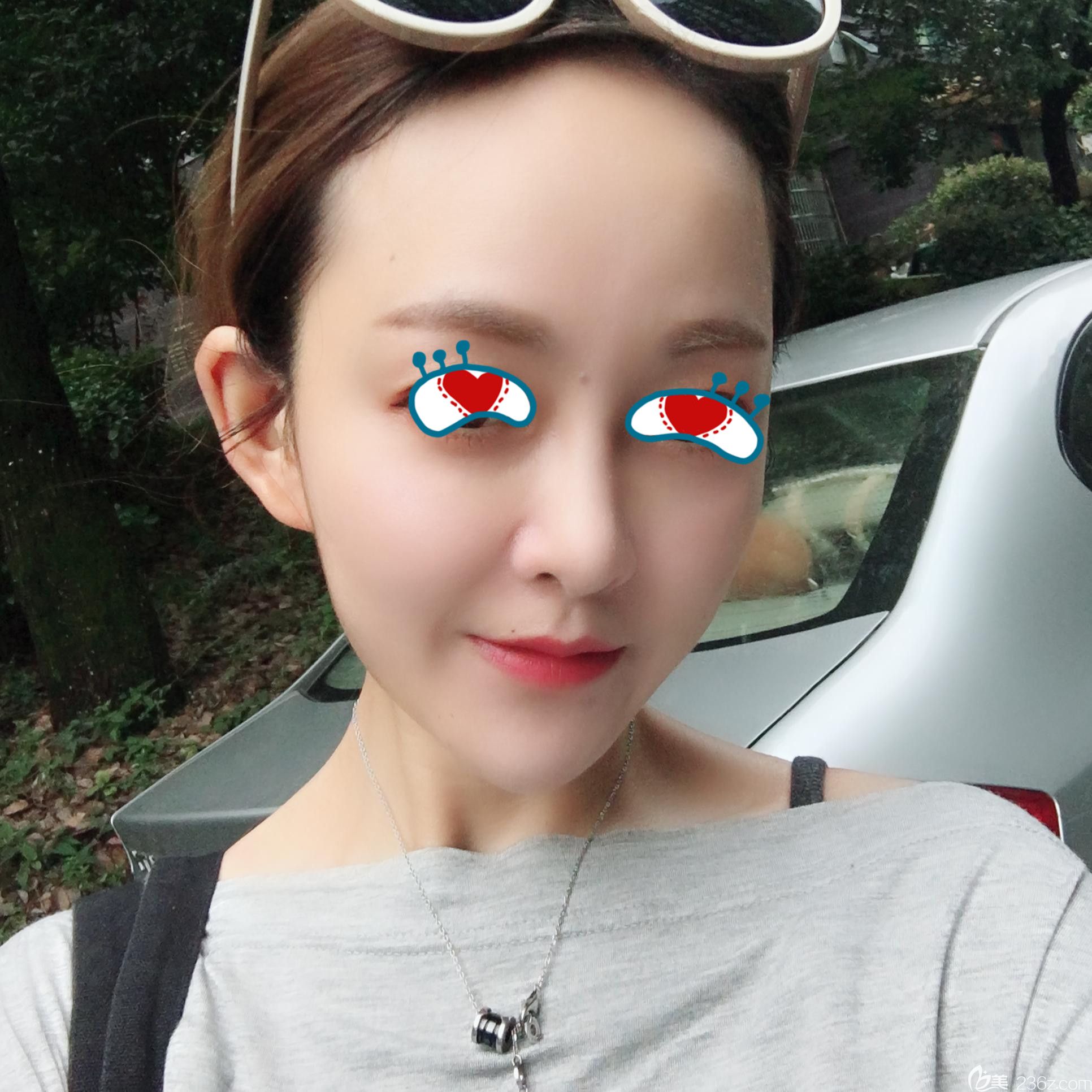 華美整形自體脂肪填充2個(gè)月恢復(fù)情況 華美整形自體脂肪填充2個(gè)月恢復(fù)情況