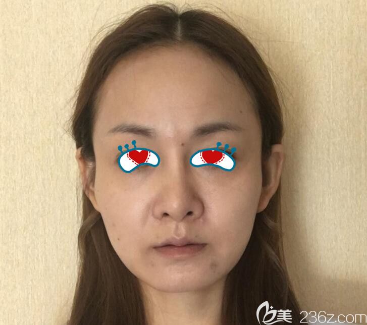 去合肥華美做自體脂肪填充前 去合肥華美做自體脂肪填充前