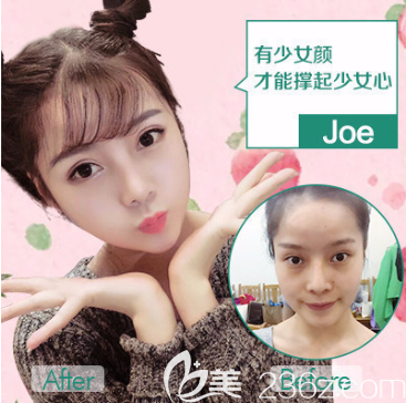 重慶華美自體脂肪填充效果怎么樣