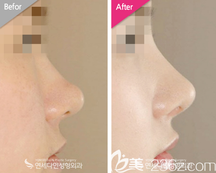 韓國延世多仁金均泰院長隆鼻案例 韓國延世多仁金均泰院長隆鼻案例