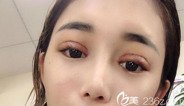 眼綜合手術(shù)第7天線條自然 眼綜合手術(shù)第7天線條自然