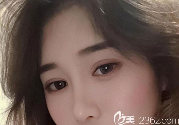 割雙眼皮兩個(gè)月沒有發(fā)現(xiàn)水腫 割雙眼皮兩個(gè)月沒有發(fā)現(xiàn)水腫