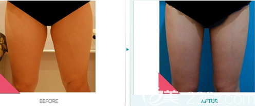 韓國(guó)DIONE吸脂皮膚門診大腿抽脂案例 韓國(guó)DIONE吸脂皮膚門診大腿抽脂案例