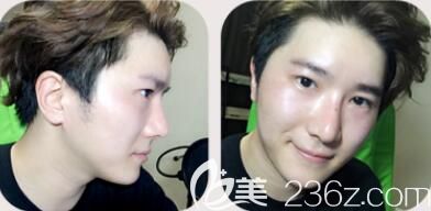 韓國然之美整形醫(yī)院雙眼皮+隆鼻+墊下巴案例術(shù)后15天效果圖