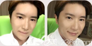 韓國哪家整形醫(yī)院好？韓國然之美眼鼻+下巴整表案例
