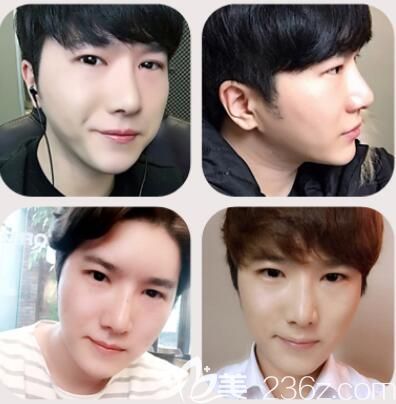 韓國做鼻子哪里好？然之美鼻綜合隆鼻術(shù)后真實恢復(fù)效果