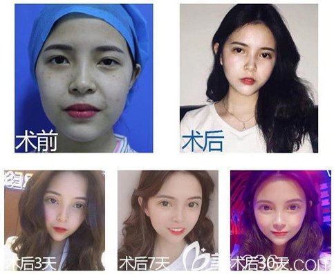 佛山華美雷朝勇醫(yī)生雙眼皮手術(shù)案例 佛山華美雷朝勇醫(yī)生雙眼皮手術(shù)案例