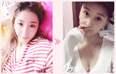 佛山華美雷朝勇隆胸案例 佛山華美雷朝勇隆胸案例