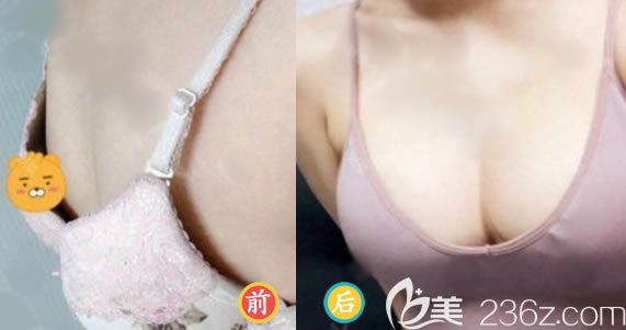 湖州尚麗宮玉展假體和自體脂肪復(fù)合隆胸案例 湖州尚麗宮玉展假體和自體脂肪復(fù)合隆胸案例