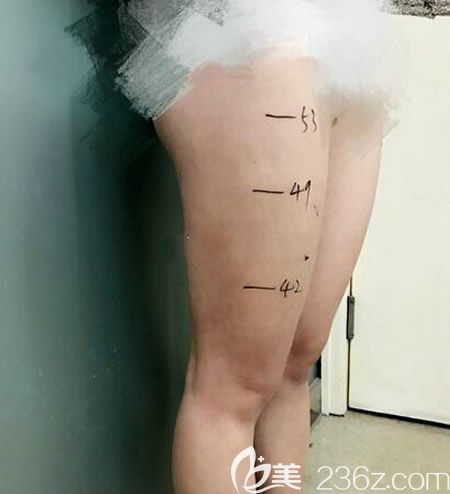 贛州亞韓吳禮誠院長給我做大腿抽脂術前設計劃線圖 贛州亞韓吳禮誠院長給我做大腿抽脂術前設計劃線圖
