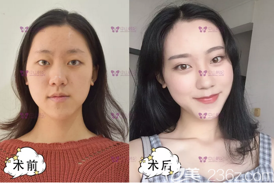 中山韓妃李光琴醫(yī)生雙眼皮案例 中山韓妃李光琴醫(yī)生雙眼皮案例