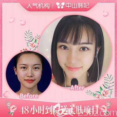 中山韓妃李光琴雙眼皮失敗修復(fù)案例 中山韓妃李光琴雙眼皮失敗修復(fù)案例