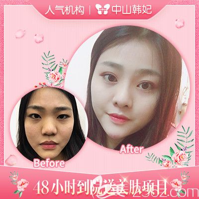 中山韓妃李光琴雙眼皮和隆鼻修復(fù)案例 中山韓妃李光琴雙眼皮和隆鼻修復(fù)案例