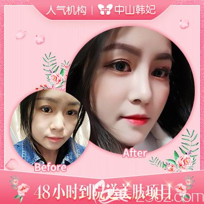 中山韓妃李光琴醫(yī)生肋軟骨隆鼻案例 中山韓妃李光琴醫(yī)生肋軟骨隆鼻案例