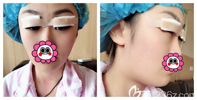 剛做完韓式切開+開眼角+祛皮/祛脂術(shù)后即刻