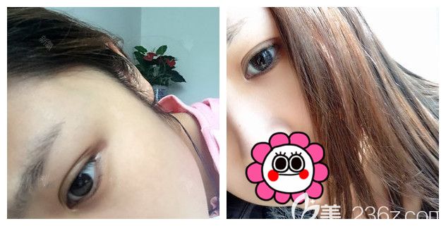 眼部綜合整形術(shù)后一周恢復(fù)效果