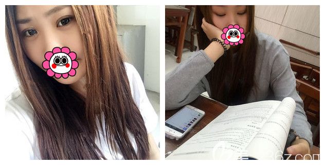 找張悅迪醫(yī)生做眼綜合術(shù)后一個(gè)月效果