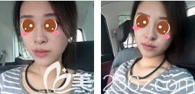 <!--<i data=20240703-sp></i>-->光博士醫(yī)療美容門診部吳莉平玻尿酸隆鼻真人案例術(shù)后第二天