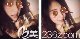 <!--<i data=20240703-sp></i>-->光博士醫(yī)療美容門診部吳莉平玻尿酸隆鼻真人案例術(shù)后十五天