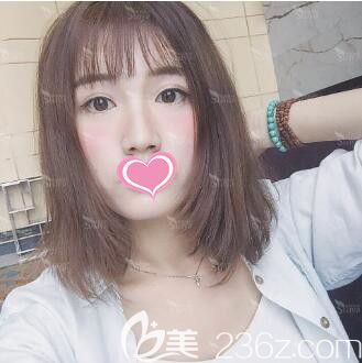 為了解決大小眼一單一雙的問題我跑去長沙星雅整形醫(yī)院做了全切雙眼皮，這效果讓我很是吃驚啊！