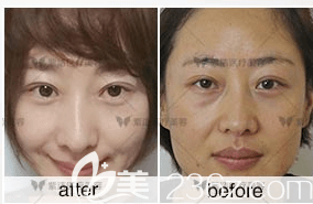 北京紫潔醫(yī)美張金娥去眼袋案例