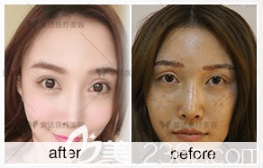 北京紫潔醫(yī)美王春燕去眼袋案例