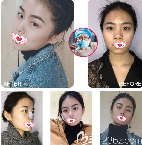 華美醫(yī)學(xué)美容醫(yī)院做隆鼻手術(shù)案例