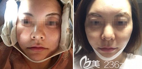 在韓國(guó)ARTLINE皮膚科做埋線提升手術(shù)當(dāng)天