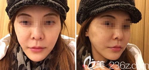 在韓國(guó)ARTLINE皮膚科做埋線提升術(shù)后3天