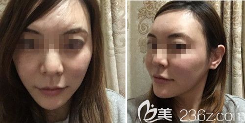 在韓國(guó)ARTLINE皮膚科做埋線提升后10天