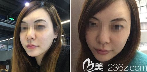 在韓國(guó)ARTLINE皮膚科做埋線提升后1個(gè)月