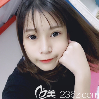 汕頭曙光割雙眼皮多少錢？我找殷運(yùn)成醫(yī)生做的眼綜合花了一萬多元效果還不錯(cuò)