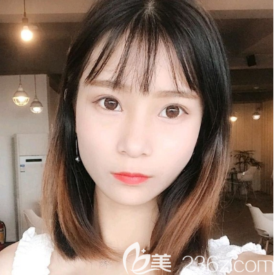 花一萬多元在汕頭曙光做的全切雙眼皮效果 花一萬多元在汕頭曙光做的全切雙眼皮效果