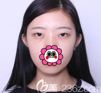 在北京壹加壹做眼綜合之前樣子 在北京壹加壹做眼綜合之前樣子