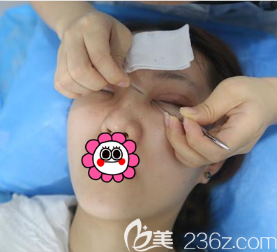 丁洪如醫(yī)生給我做眼綜合設(shè)計照 丁洪如醫(yī)生給我做眼綜合設(shè)計照