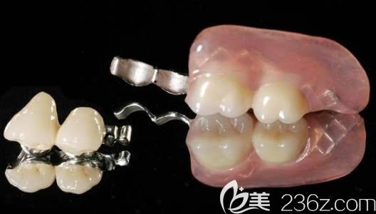 口腔精密附著體圖片展示 口腔精密附著體圖片展示