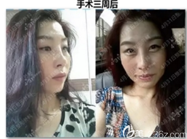 4月31日整形外科金載勛動態(tài)鼻尖手術(shù)拯救鼻整形失敗痛苦妹子！