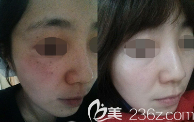 韓國美典皮膚科激光祛斑案例 韓國美典皮膚科激光祛斑案例