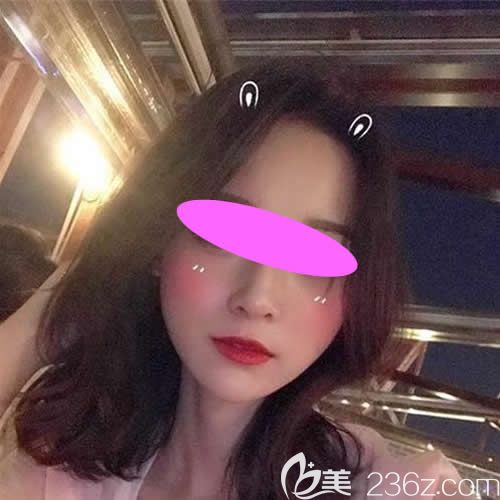 花8600塊找上饒尚美整形張維華做膨體+耳軟骨隆鼻三個月后，朋友都說這錢沒白花